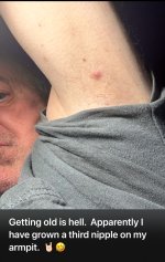 Third Nipple under armpit.jpg